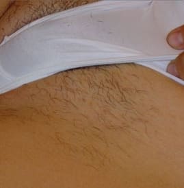 Before - Female bikini line