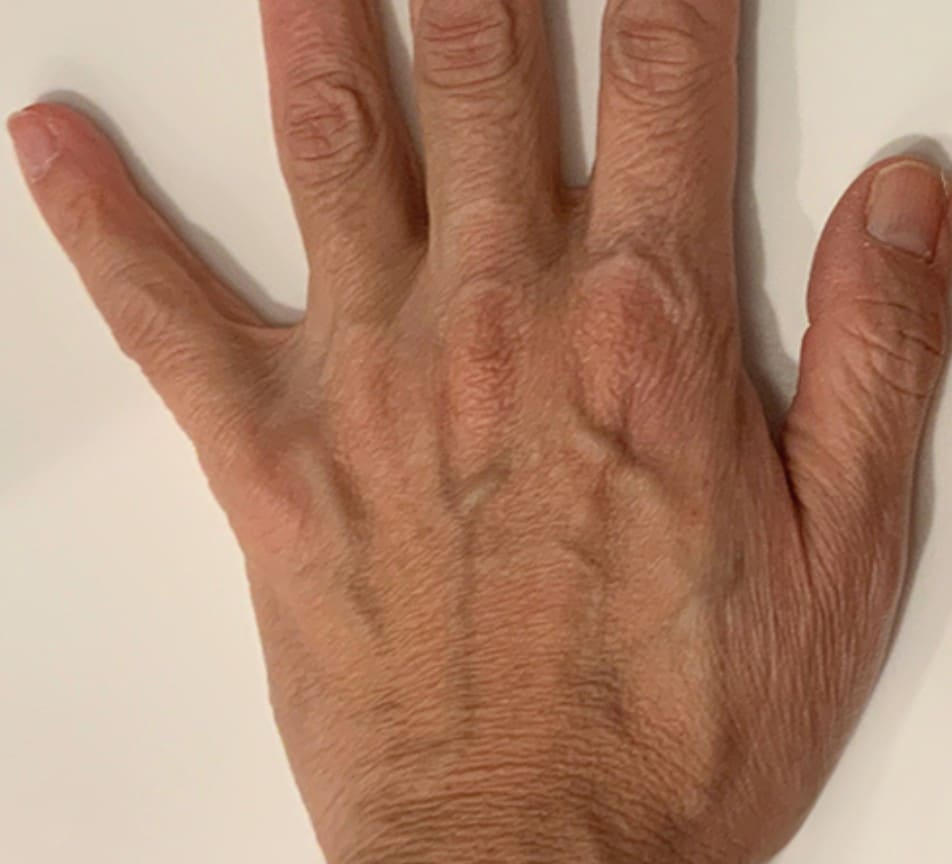 Before - Hand rejuvenation