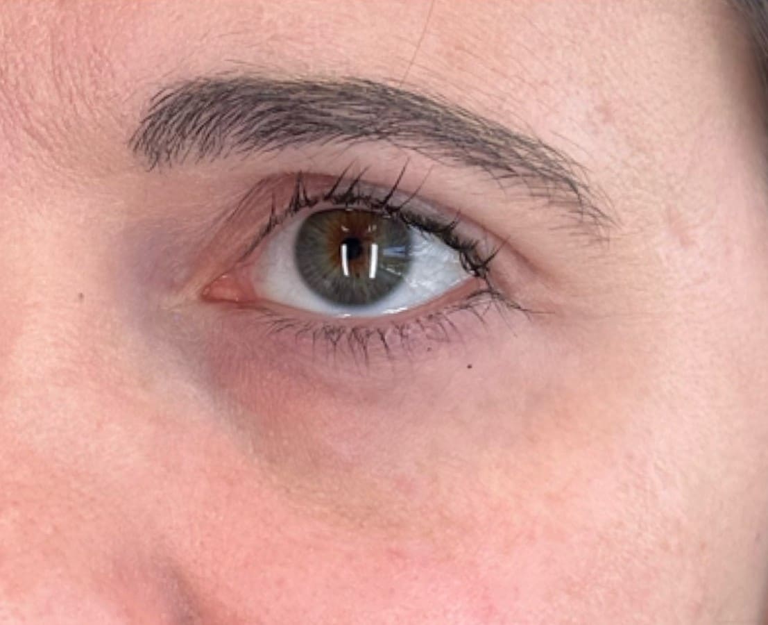 After - Tear troughs (under-eye hollows)