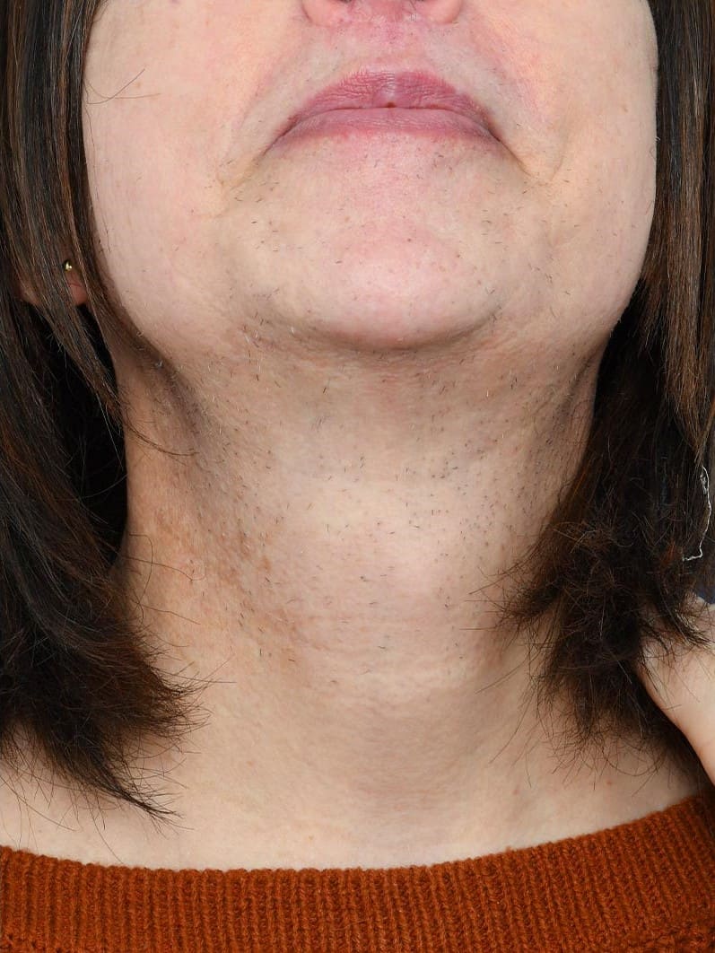 Before - Chin and neck grey hair removal
