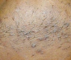 Before - Female underarm