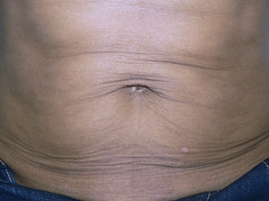 Before - Abdominal skin tightening