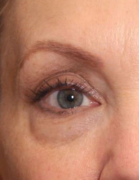 Before - Eye area rejuvenation