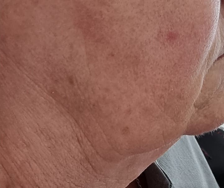 Before - Sun damage and age spots