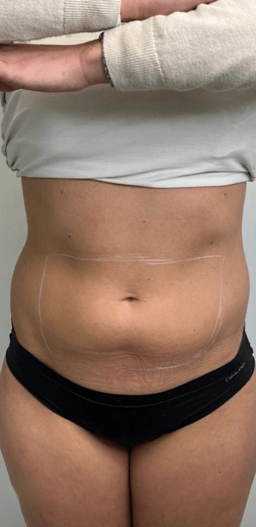 Before - Abdominal skin tightening