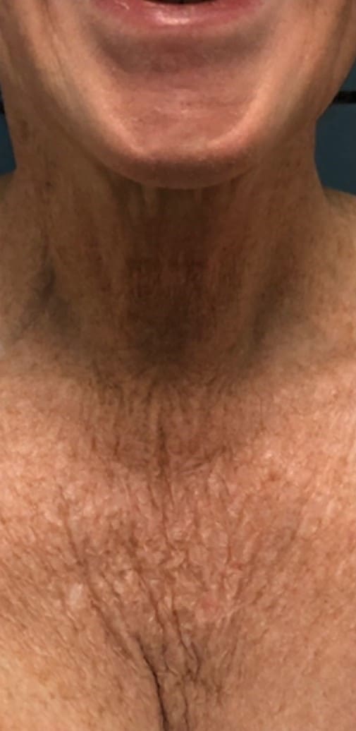 Before - Décolletage tightening