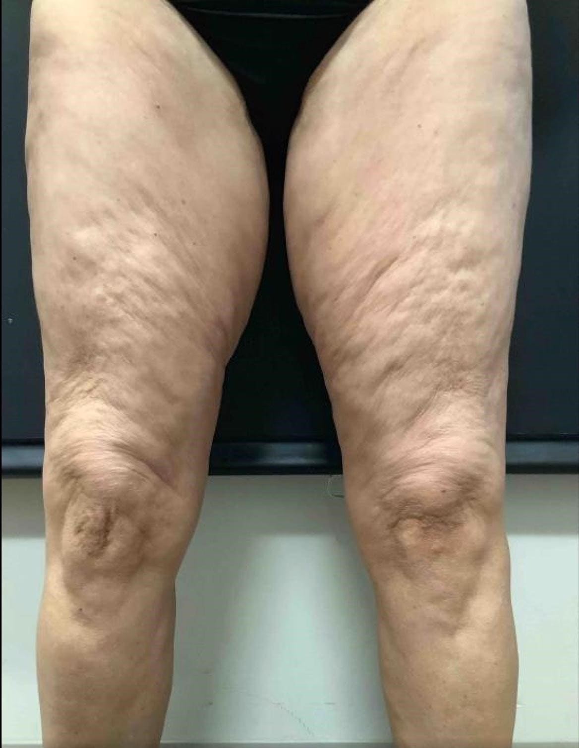 Before - Body skin tightening