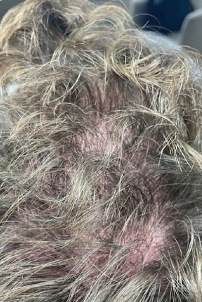 Before - Keravive Hydrafacial