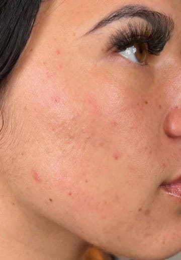 Before - Platinum Hydrafacial