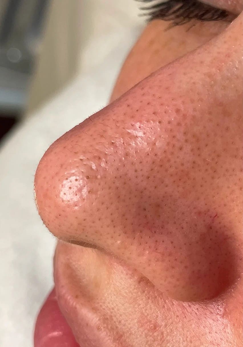 Before - Signature Hydrafacial