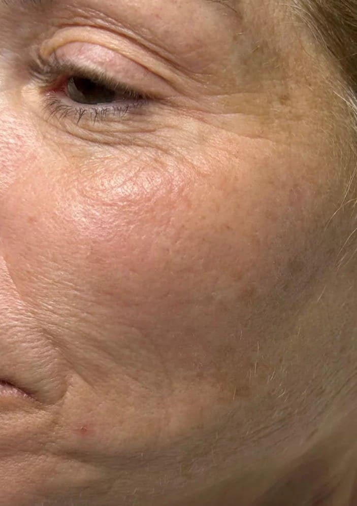 Before - Juvederm Volite treatment
