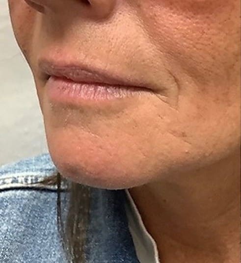 Before - Asymmetry correction — visible improvement in lip balance