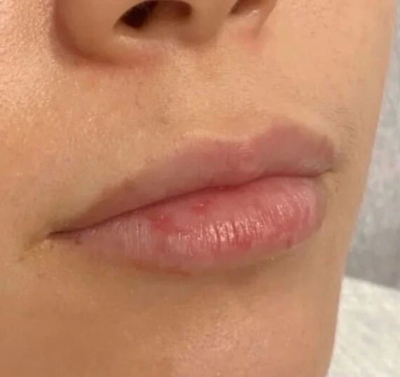 Before - Natural and subtle volume enhancement