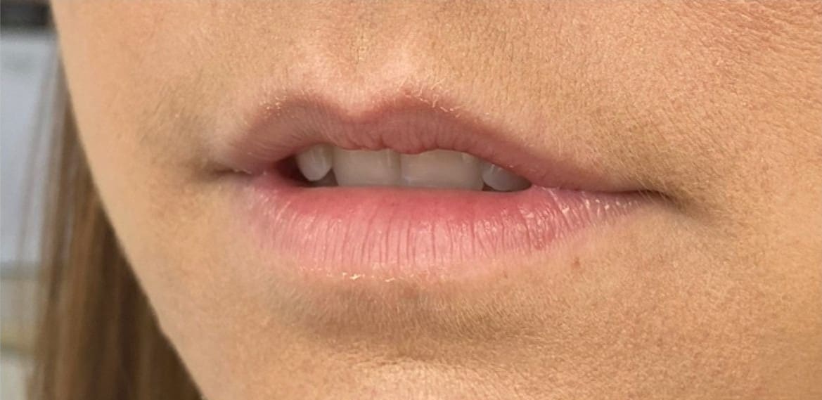 Before - Balanced volume increase — proportional enhancement