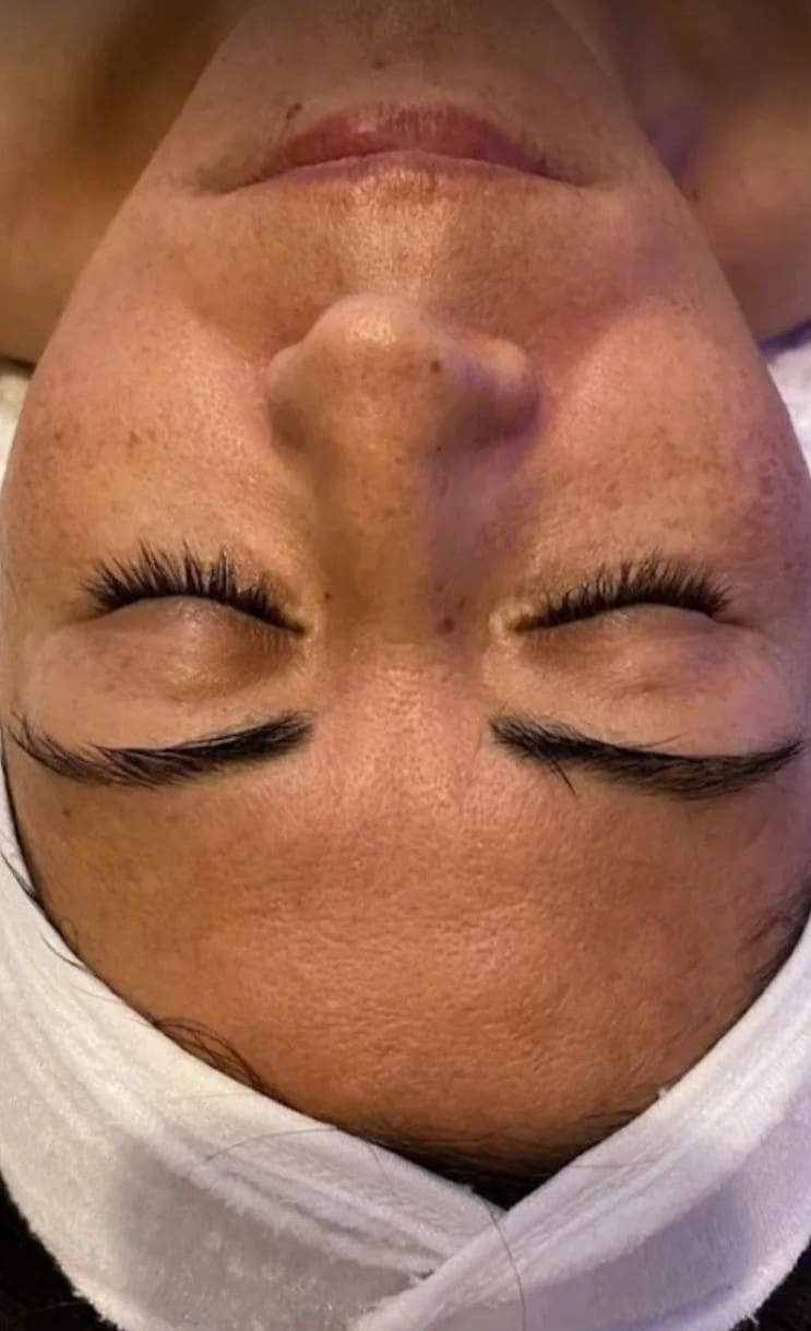 Before - Smoother, more refined skin texture