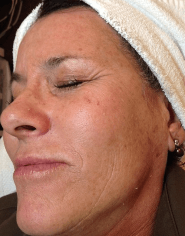 Before - Brighter, smoother and more refined skin