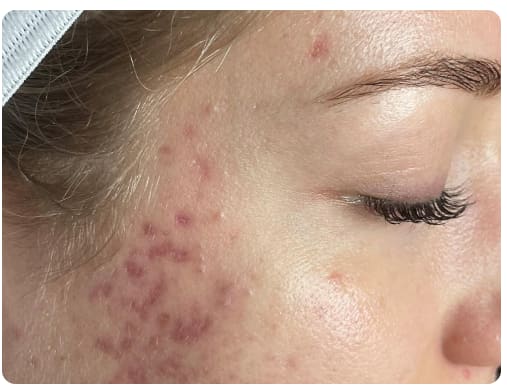 Before - Acne Clearance