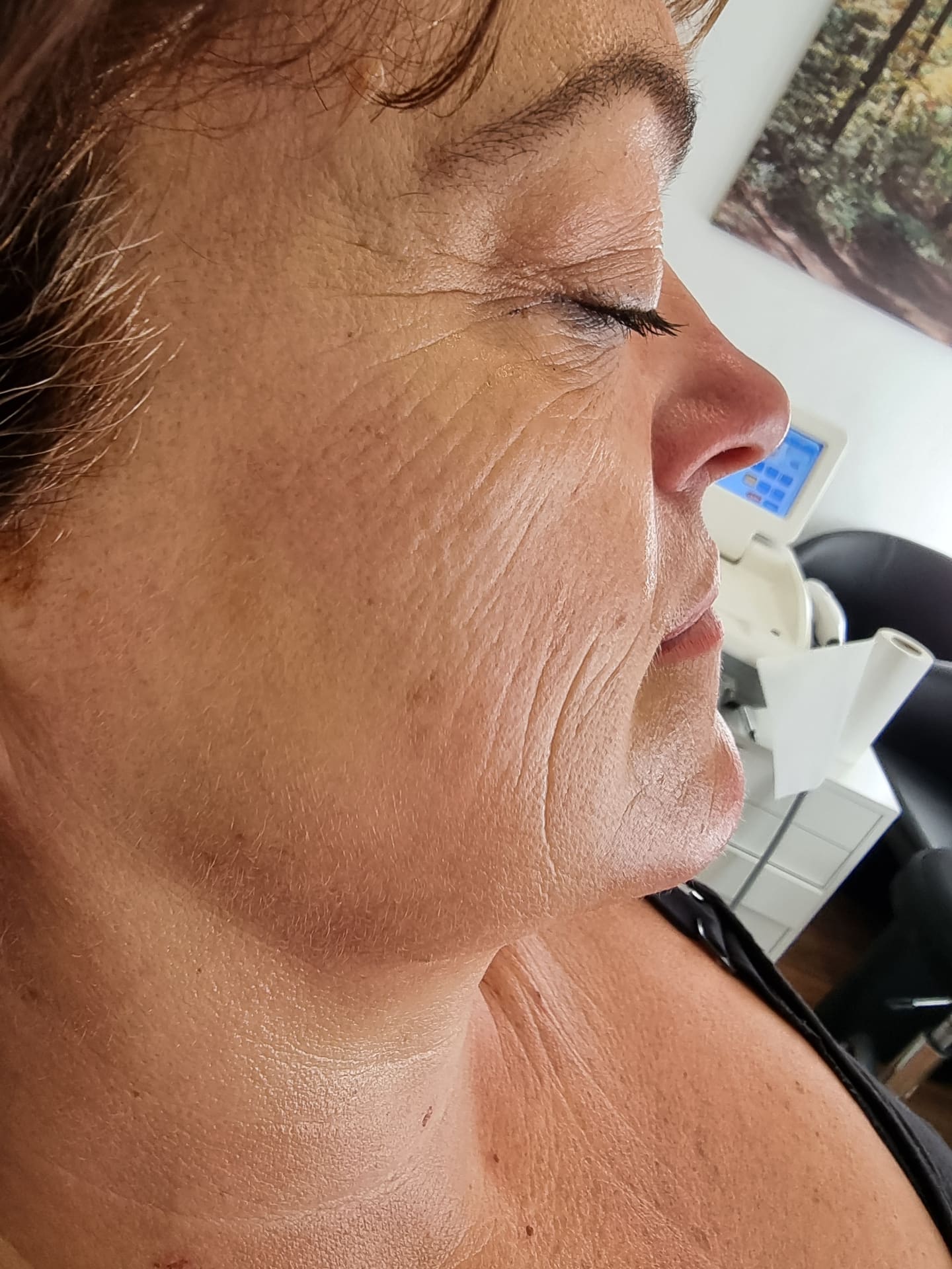 Before - Skin Rejuvenation