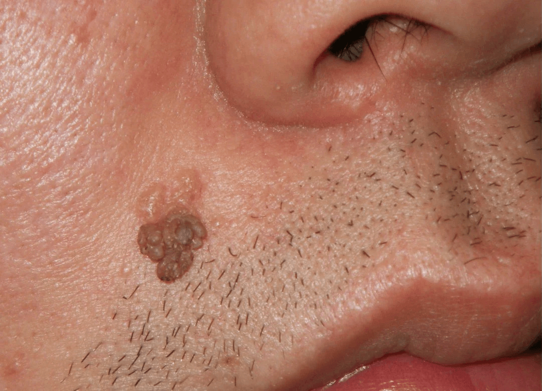 Before - Lip Seborrheic Keratosis