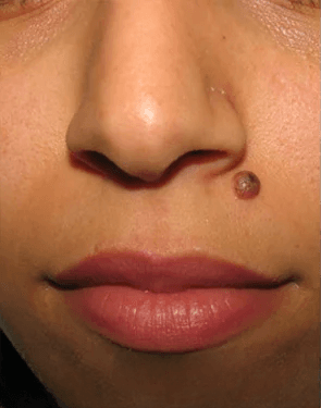 Before - Lip Seborrheic Keratosis