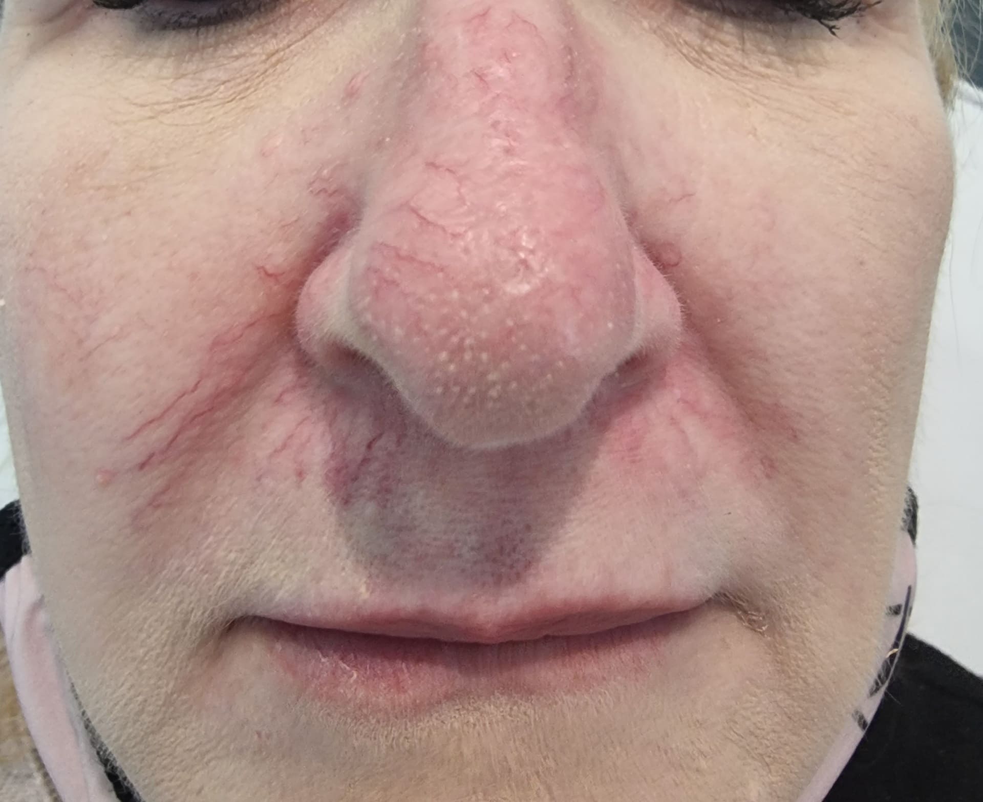 Before - Nasal area thread vein removal