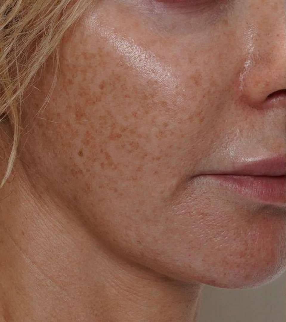 Before - Freckles (Ephelides) + sun damage