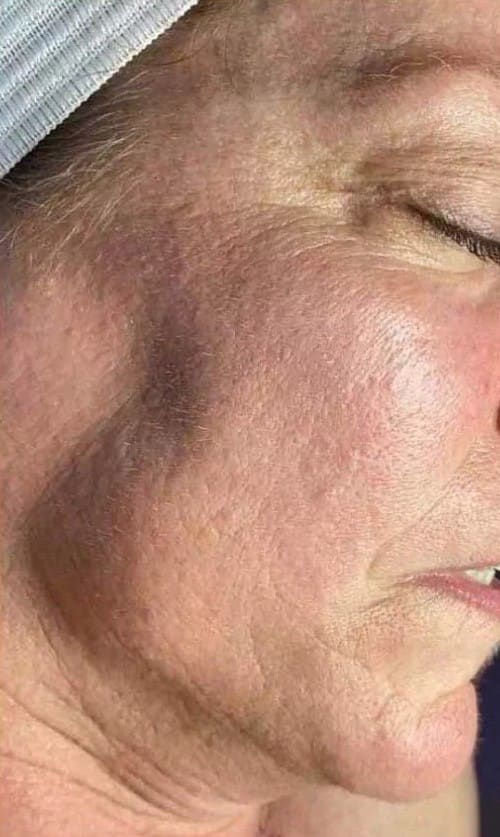 Before - Radiant 30 (Mandelic + Lactic)
