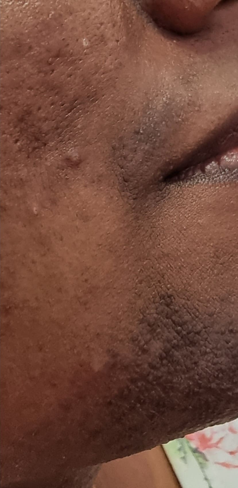 Before - Post-Inflammatory Hyperpigmentation (PIH)