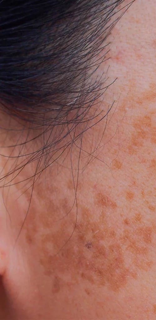 Before - Sun damage & age spots