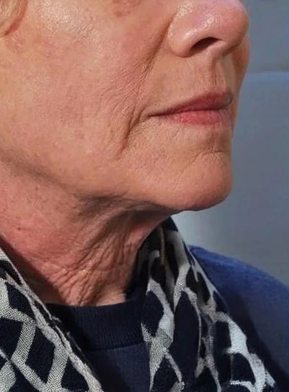 Before - Profhilo treatment