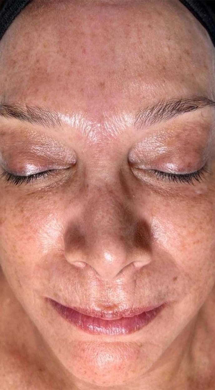 Before - Seventy Hyal rejuvenation