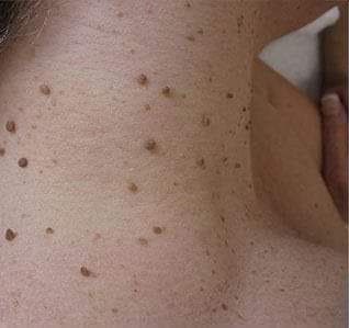 Before - Neck Skin Tags (Acrochordons)