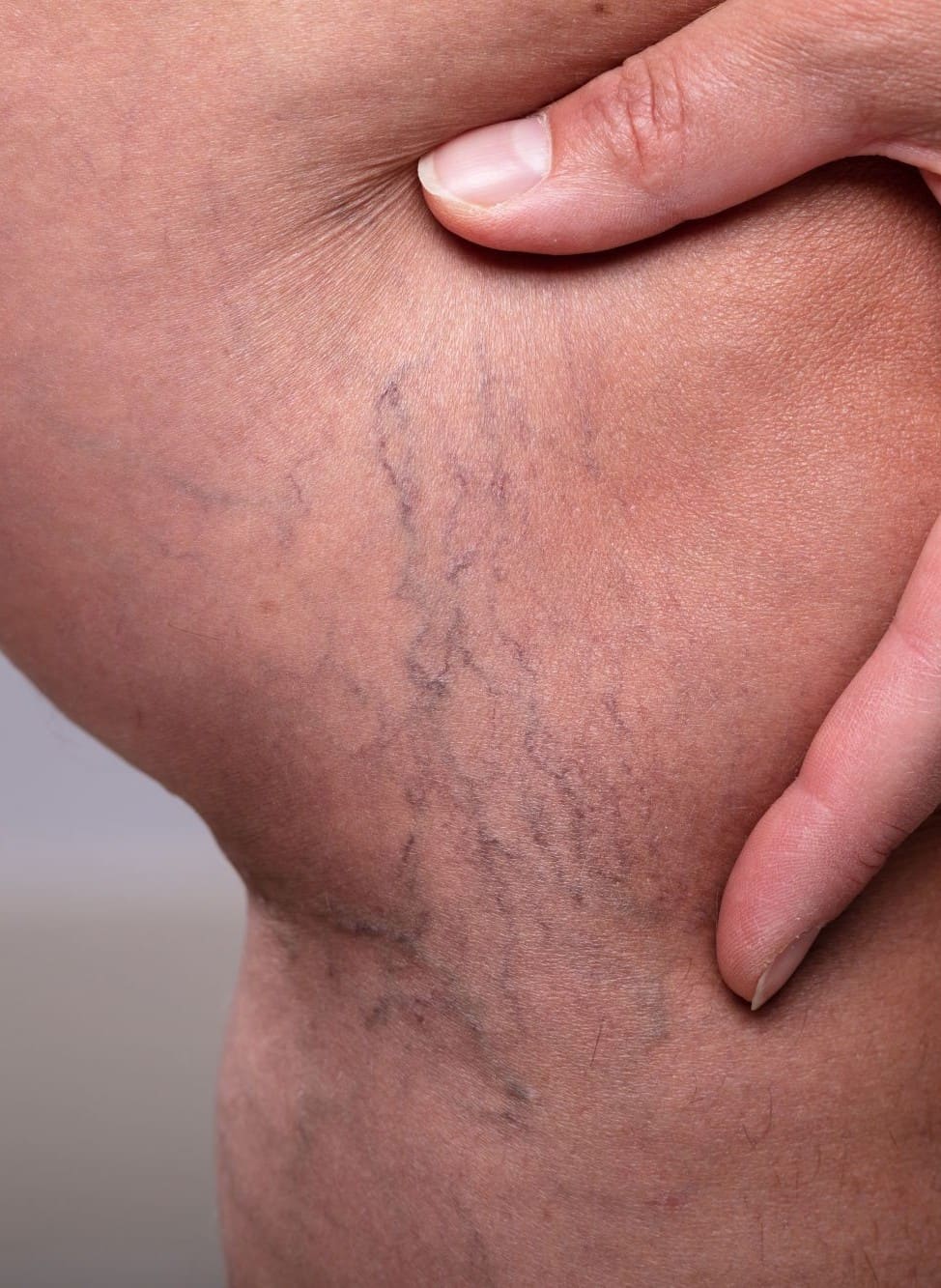 Before - Thigh thread vein removal