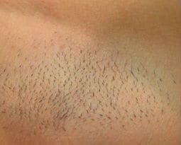 Before - Female underarm