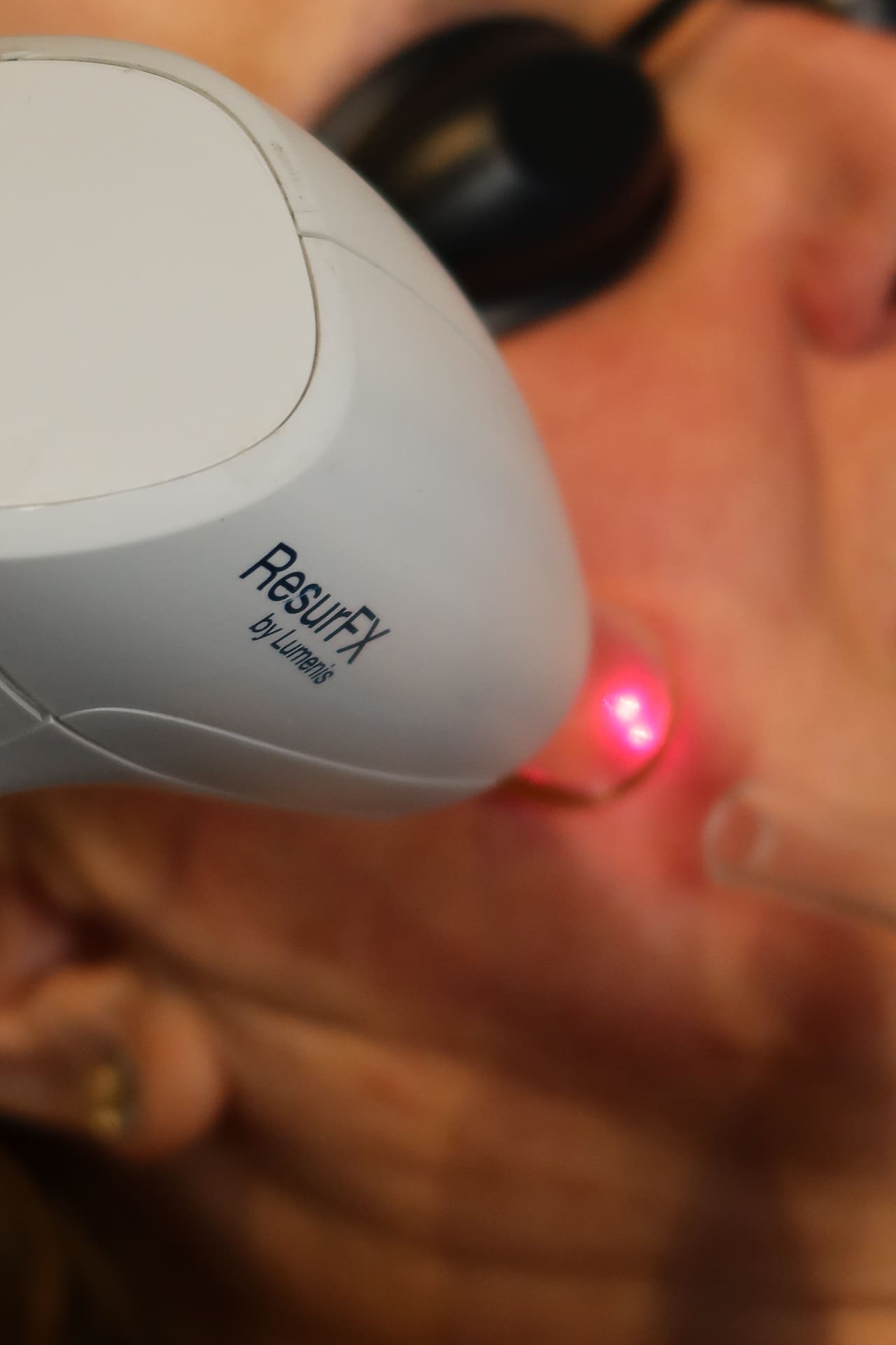 Cardiff laser hair removal client at Vale Laser Cardiff Gate
