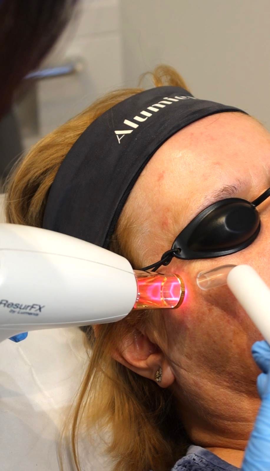 Advanced fractional laser technology