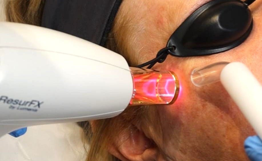 Fractional Laser Resurfacing & Photofractional