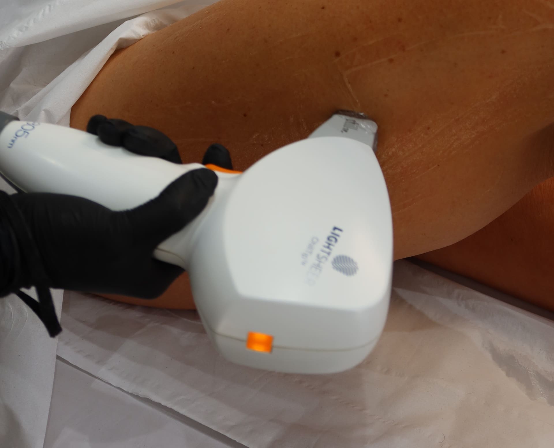 Laser hair removal treatment