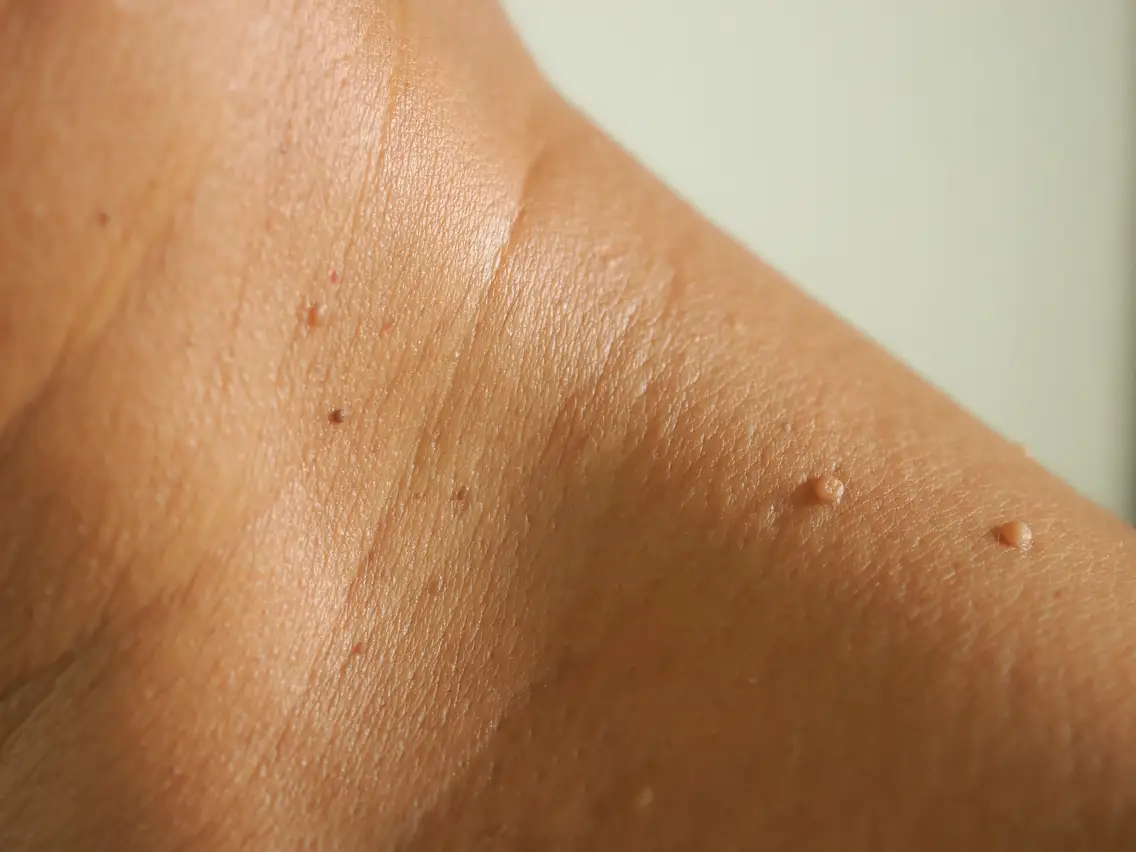 Professional skin tag and mole removal clinic