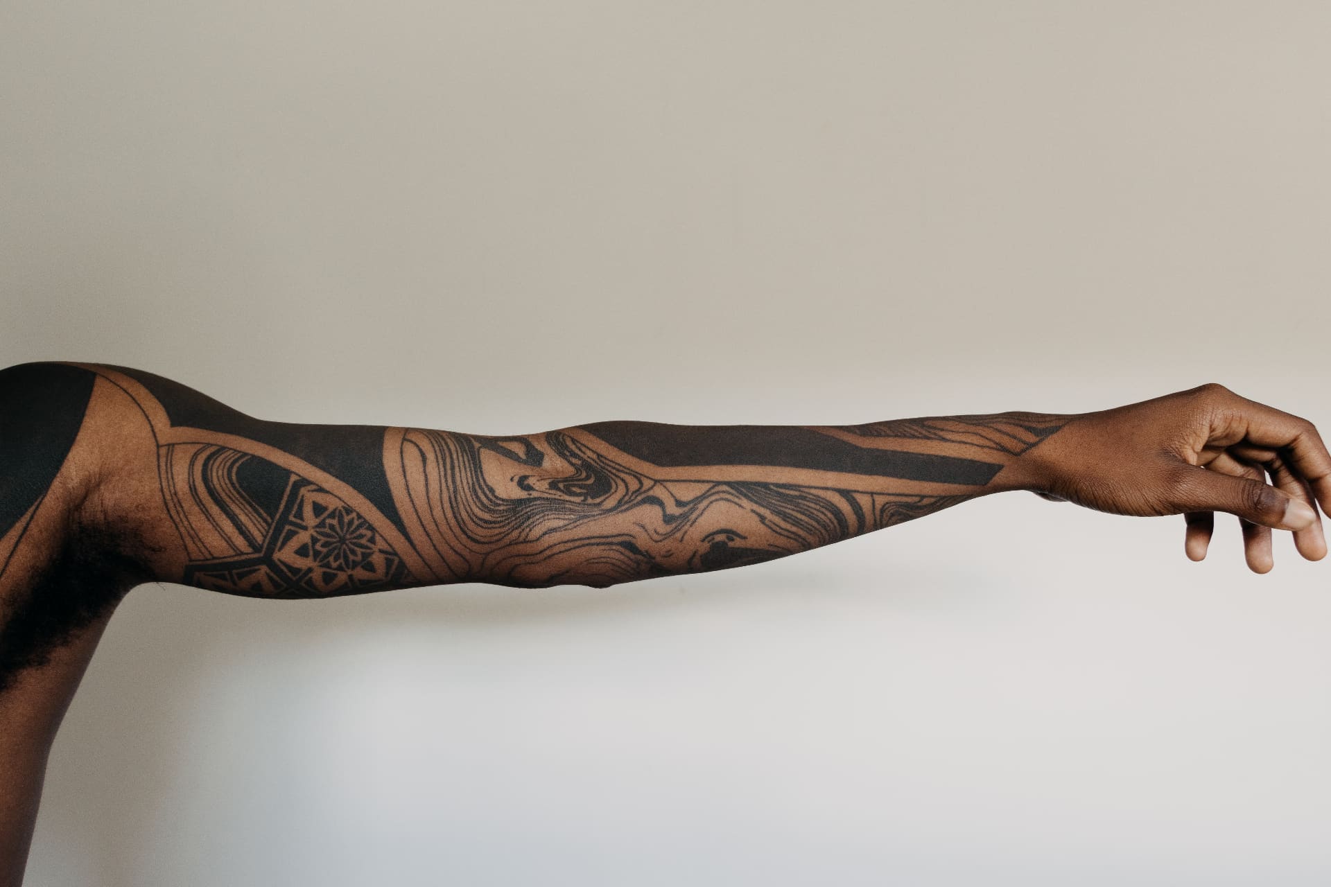 Laser tattoo removal treatment
