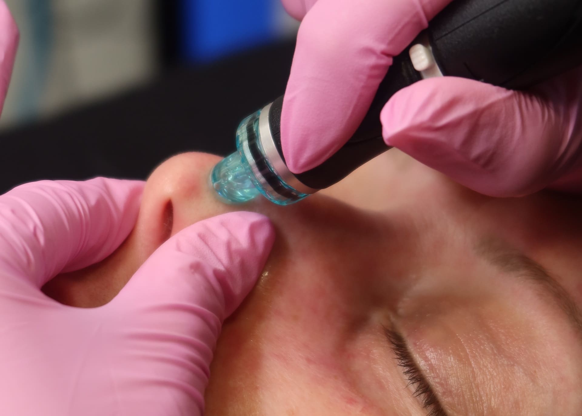 Microneedling (SkinPen)