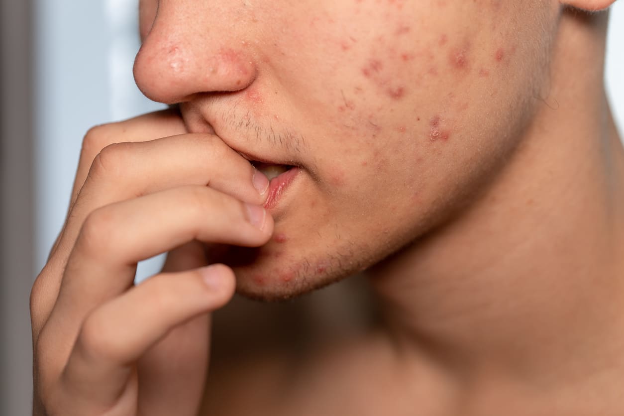 Acne & Scarring Treatments