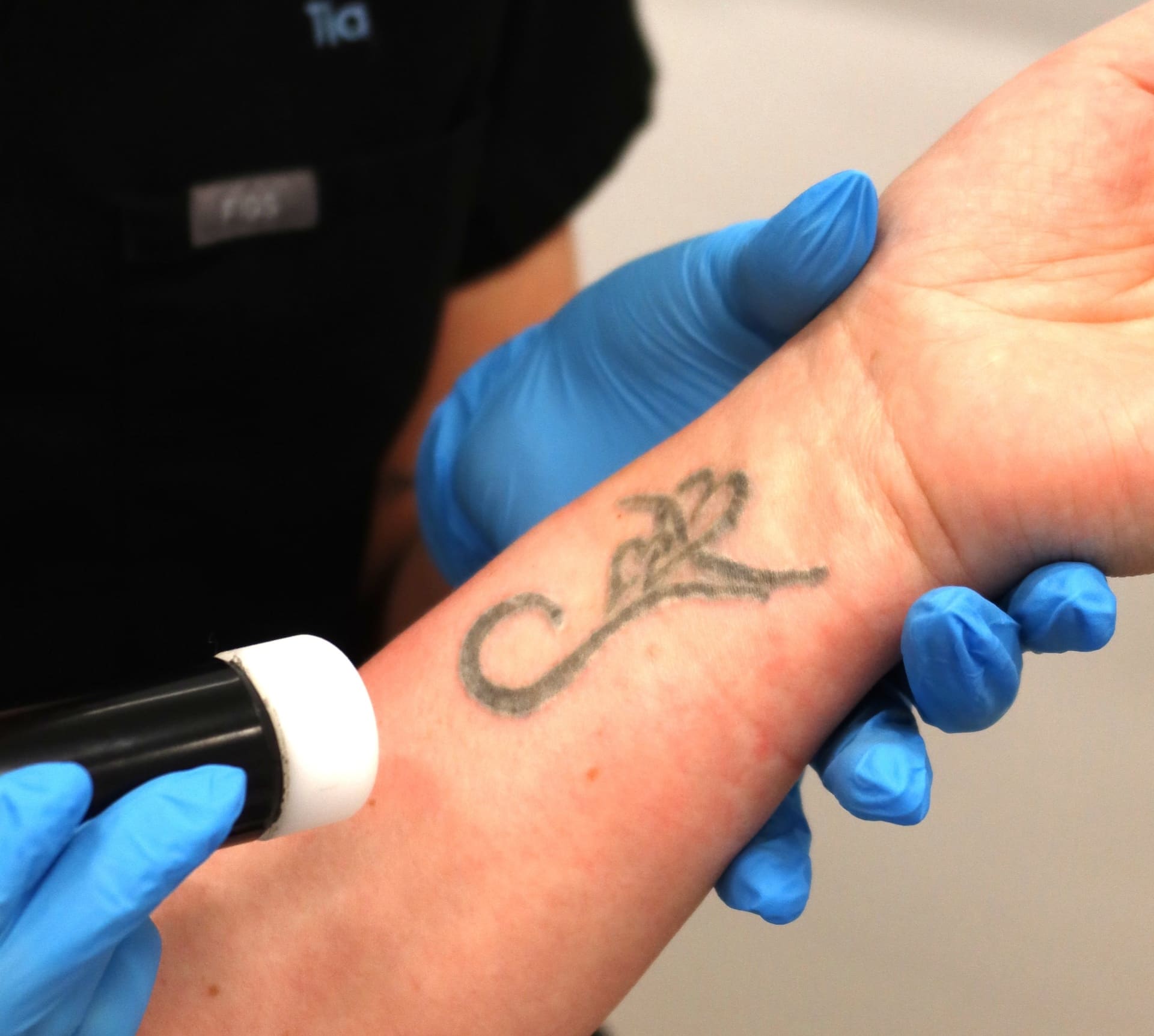 Tattoo removal