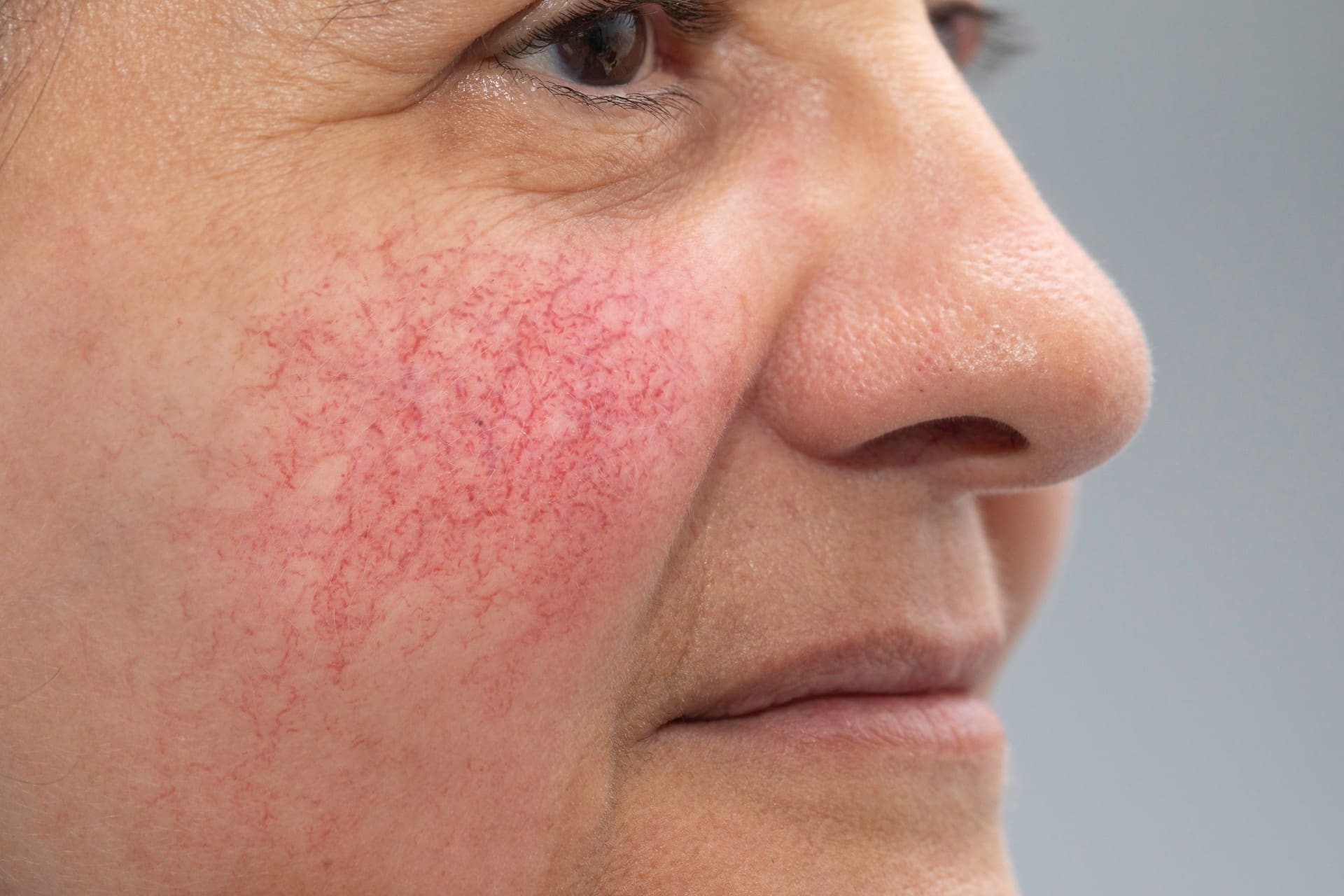 Thread vein removal