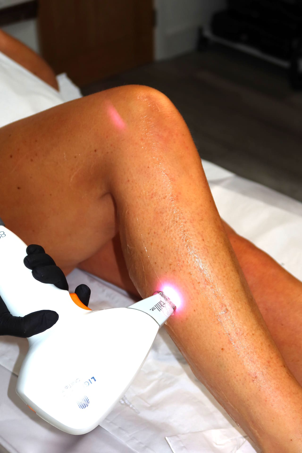 Laser Hair Removal