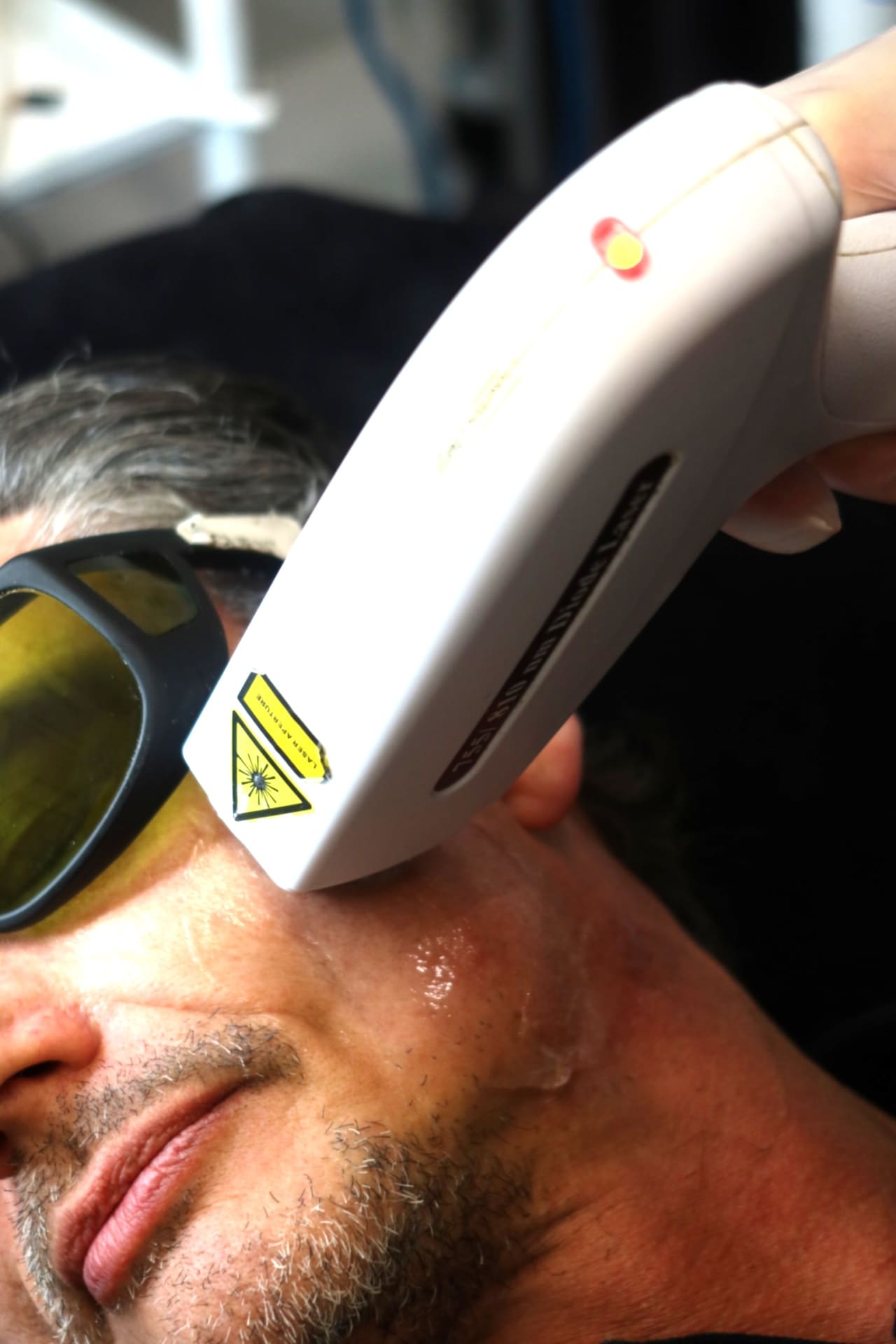 Fractional Laser