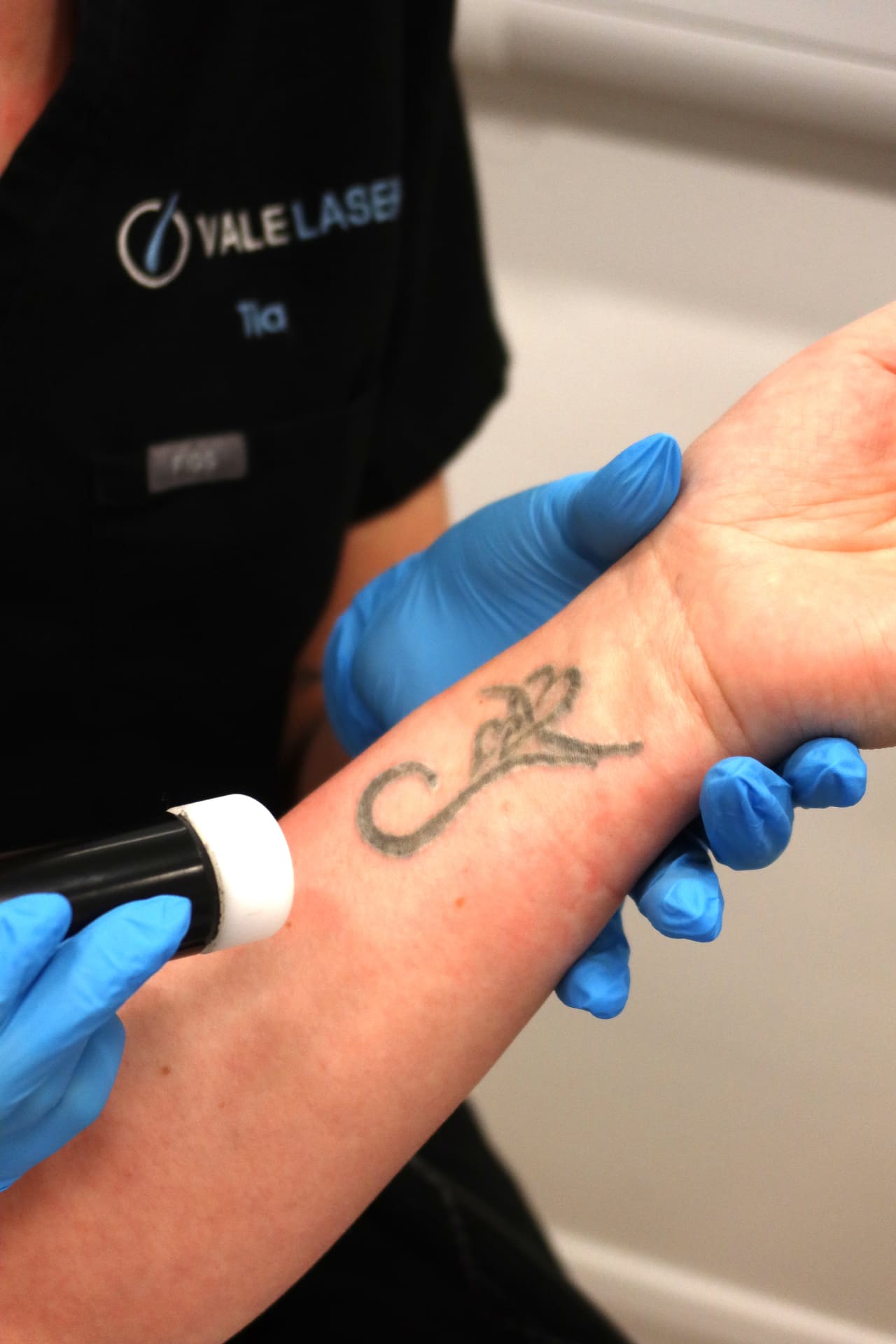 Tattoo Removal